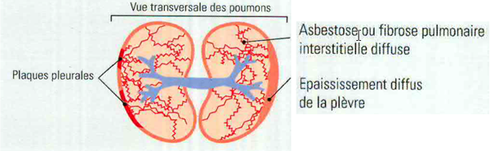 Schéma plaques pleurales